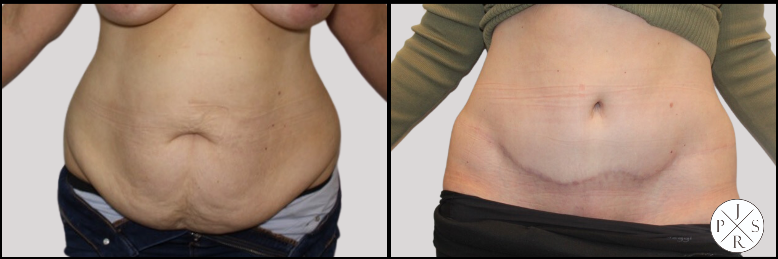 Abdominoplasty Before & After Image